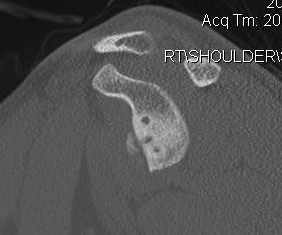 Revison Shoulder Stabilisation CT Bony Defect